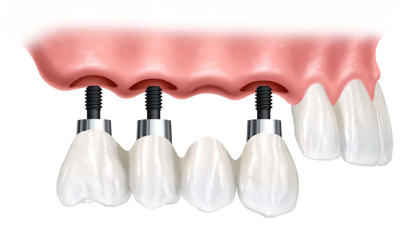 dental implants supported dentures