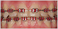 Metal Orthodontic Braces